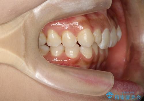 乳歯が残っていた人の矯正治療の治療前