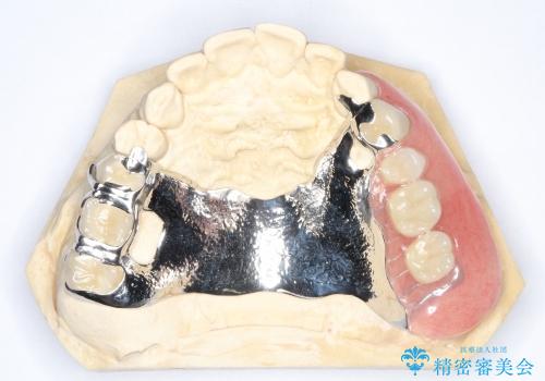 セラミックの被せ物と自費の入れ歯による咬合の改善の治療後