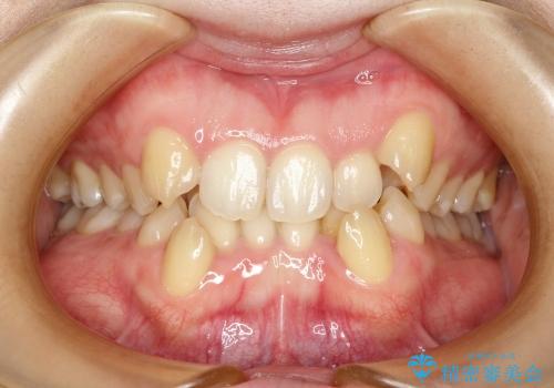 20代女性　八重歯を治したい　審美装置での抜歯矯正の治療前