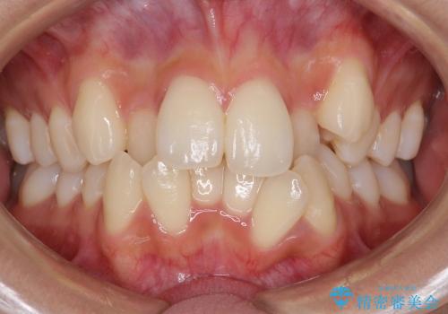 前歯のがたがた　根の短い歯を優先的に抜歯