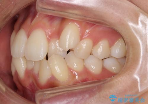 前歯のがたがた　根の短い歯を優先的に抜歯の治療前