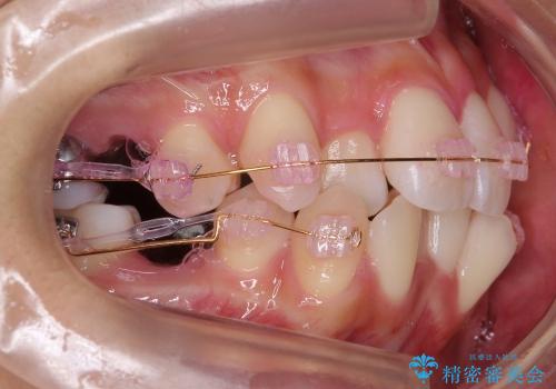 前歯のがたがた　根の短い歯を優先的に抜歯の治療中