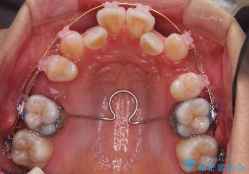 前歯のがたがた　根の短い歯を優先的に抜歯の治療中