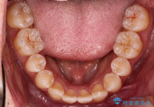乳歯が残っていた人の矯正治療の治療後