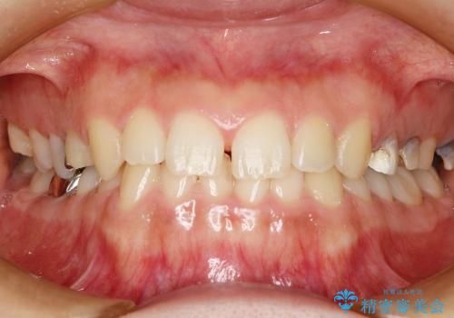 前歯の矯正 / 奥歯のインプラント治療