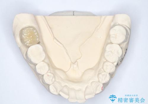 セラミックの被せ物と自費の入れ歯による咬合の改善の治療中