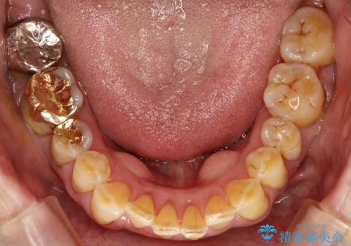 セラミックの被せ物と自費の入れ歯による咬合の改善の治療前
