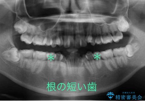 前歯のがたがた　根の短い歯を優先的に抜歯の治療前