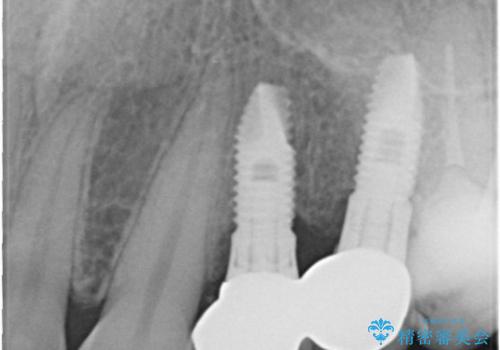 前歯の矯正 / 奥歯のインプラント治療の治療後