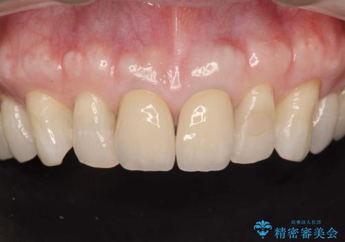 [感染根管治療] 根管治療を伴った前歯部精密審美治療の治療後