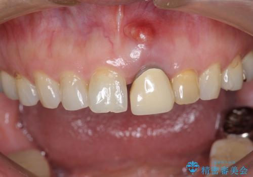 [歯肉の移植] 審美性を改善した前歯ブリッジ治療の治療前