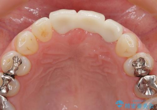 [歯肉の移植] 審美性を改善した前歯ブリッジ治療の治療後