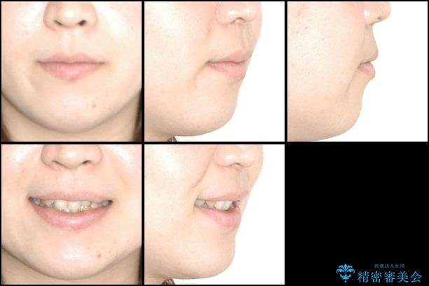 20代女性　八重歯を治したい　審美装置での抜歯矯正の治療前（顔貌）