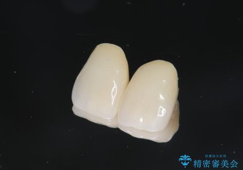 [感染根管治療] 根管治療を伴った前歯部精密審美治療