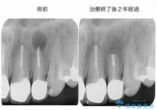 マイクロスコープを用いた外科的歯内療法により前歯の根尖病巣を治療した1例