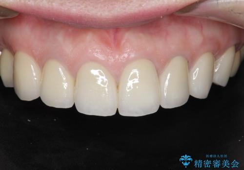 [歯ぐきの位置変化] クラウンの再作製の治療後