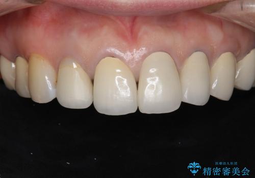 [歯ぐきの位置変化] クラウンの再作製の治療前