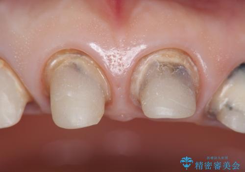 [歯ぐきの位置変化] クラウンの再作製の治療中