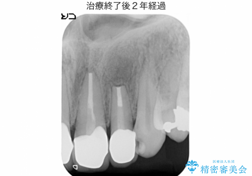 マイクロスコープを用いた外科的歯内療法により前歯の根尖病巣を治療した1例の症例 治療後