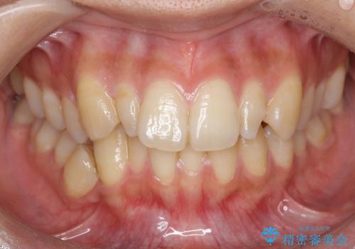 矮小歯　前歯のセラミック+矯正の症例 治療前