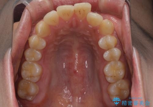 20代女性　出っ歯の矯正治療の治療前