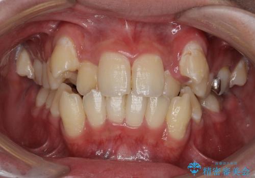 10代男子　八重歯　すれ違い咬合の症例 治療前