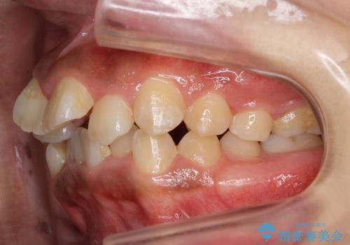 大人の出っ歯　がたがた　劇的に改善の治療前