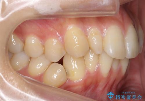 矮小歯　前歯のセラミック+矯正の治療前