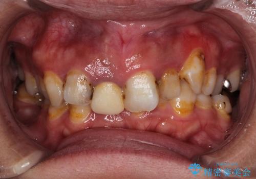 矯正してからのセラミック　歯ぐきの高さもそろえます　補綴前矯正の症例 治療前