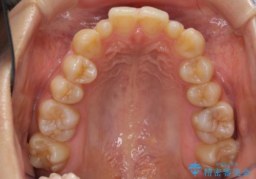 矮小歯　前歯のセラミック+矯正の治療前