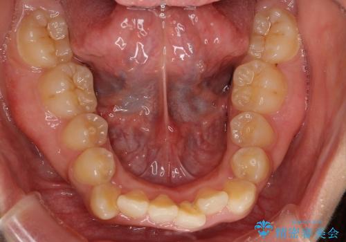 大人の出っ歯　がたがた　劇的に改善の治療前