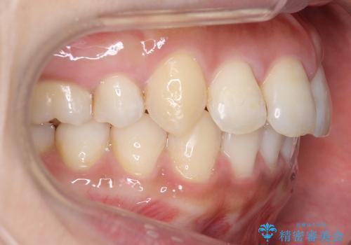 20代女性　出っ歯の矯正治療の治療後
