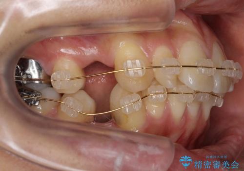 矮小歯　前歯のセラミック+矯正の治療中