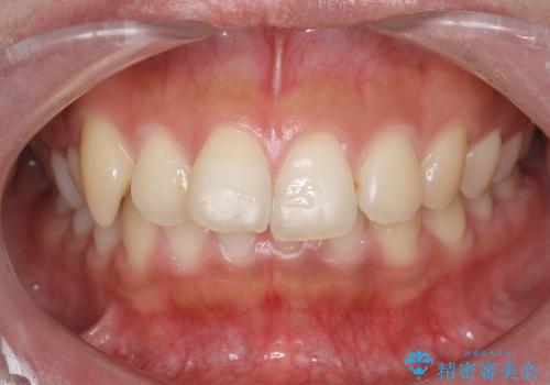 20代女性　出っ歯の矯正治療の症例 治療前