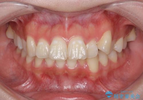 ハーフリンガル　最小限の抜歯　すれ違い咬合の症例 治療前