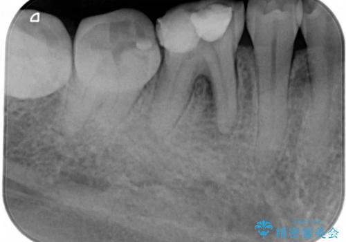 「銀歯しかできない」と言われた　奥歯のオールセラミック治療の治療前