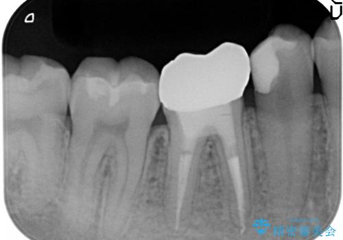 30代男性　崩壊した奥歯の修復の治療後
