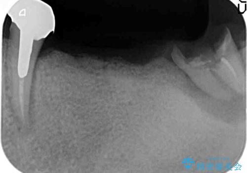[スクリューリテイン式] インプラントによる臼歯部咬合回復の治療前