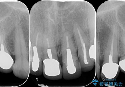 [歯ぐきの位置変化] クラウンの再作製の治療前