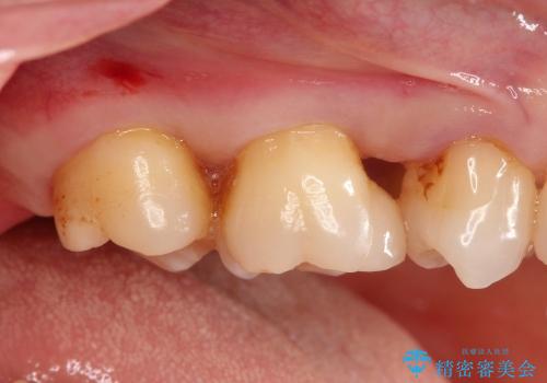 50代女性　奥歯の再生治療の症例 治療前