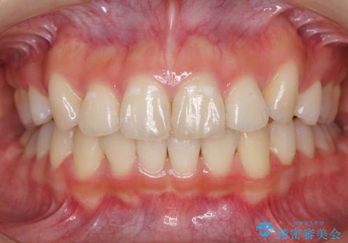 ハーフリンガル　最小限の抜歯　すれ違い咬合の症例 治療後