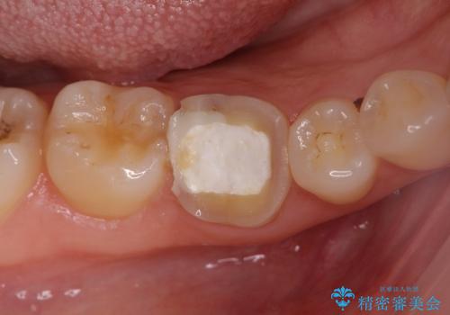 「銀歯しかできない」と言われた　奥歯のオールセラミック治療の症例 治療前