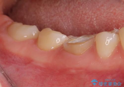「銀歯しかできない」と言われた　奥歯のオールセラミック治療の治療前