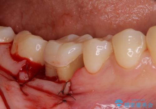 「銀歯しかできない」と言われた　奥歯のオールセラミック治療の治療中