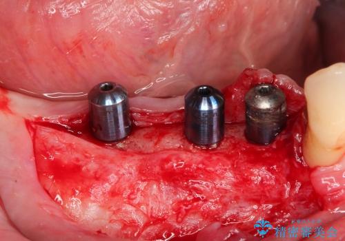 50代男性　インプラント部への歯肉移植の治療中