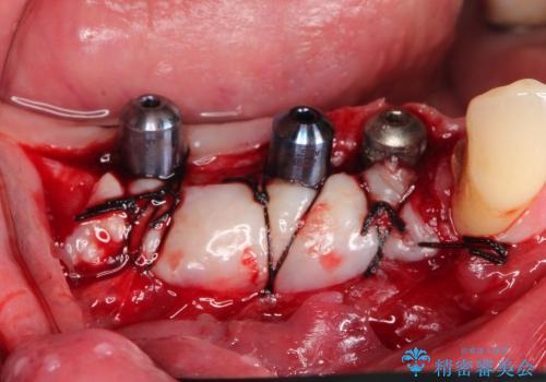 50代男性　インプラント部への歯肉移植
