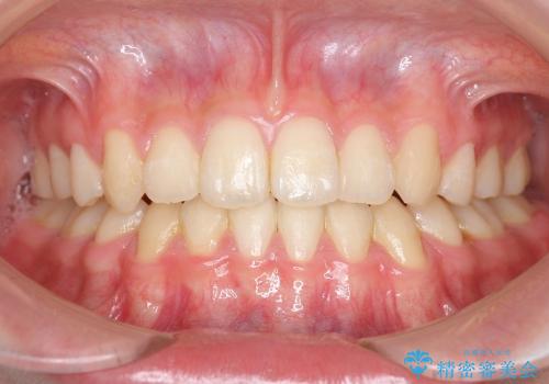 10代女性 前歯のねじれの症例 治療後