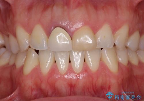 30代女性　色違いの前歯をセラミックできれいにの治療前