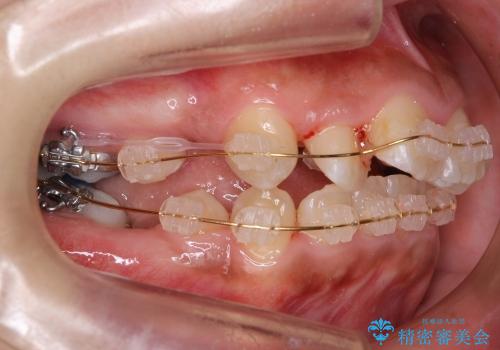 大人の出っ歯　がたがた　劇的に改善の治療中