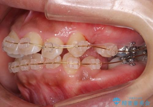 大人の出っ歯　がたがた　劇的に改善の治療中